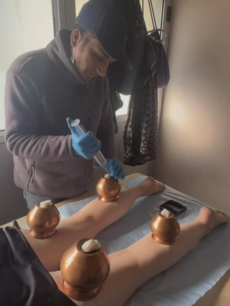 カトマンドゥで瀉血 カッピング